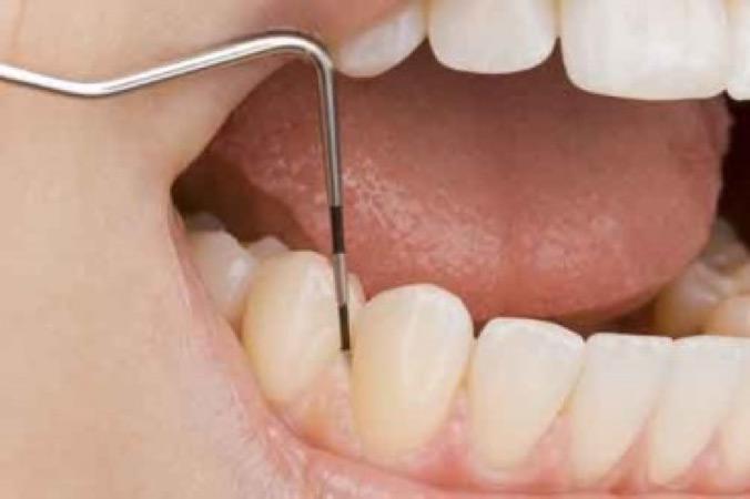 full mouth probe for deep pockets in gums - periodontal care