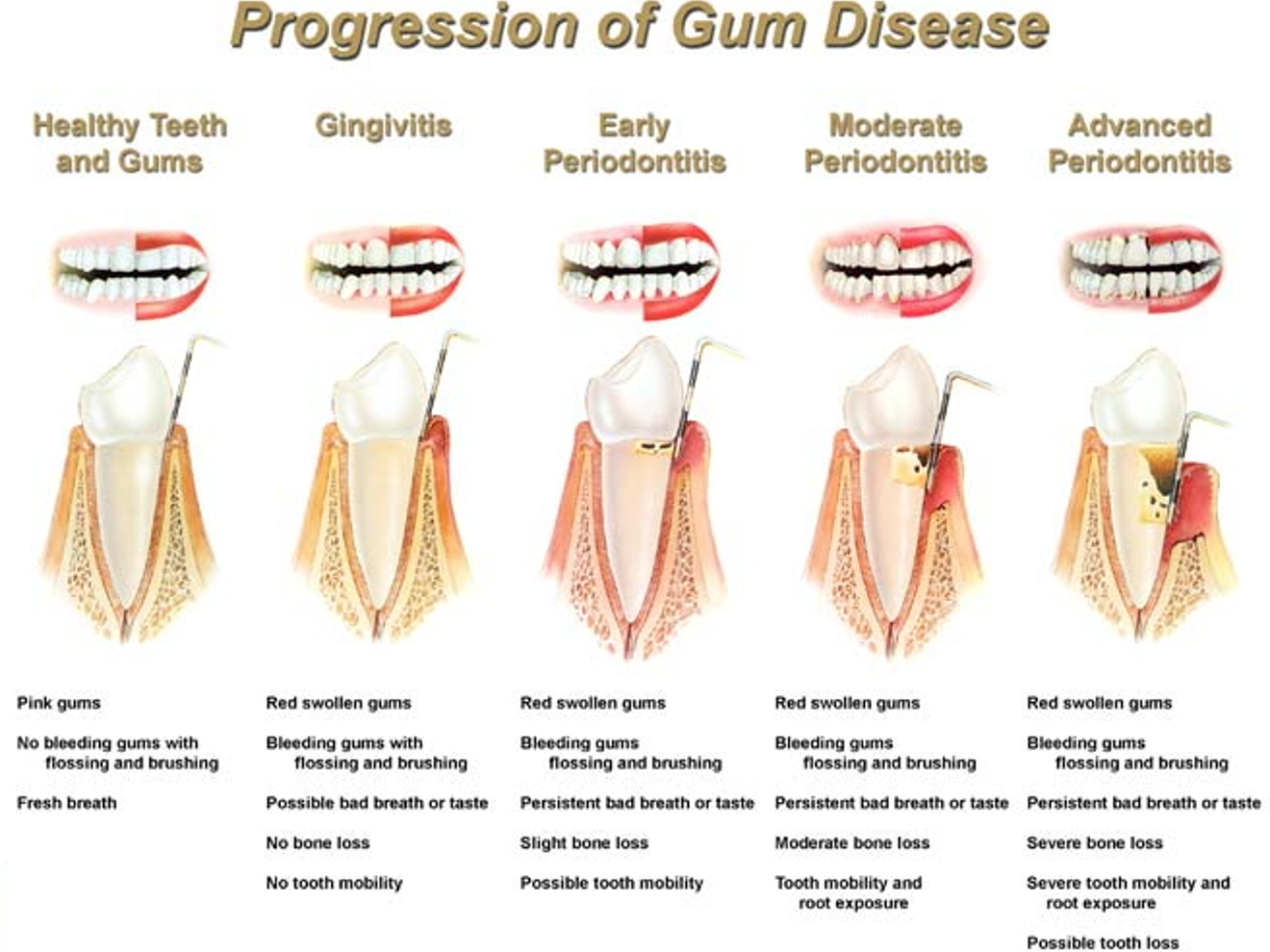 full mouth exam for periodontal disease 