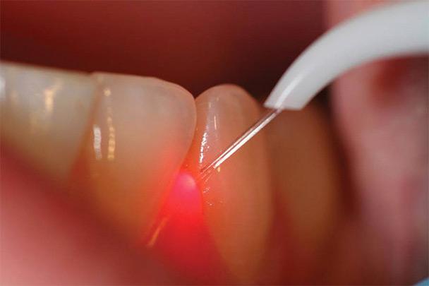 laser treatment for periodontitis and gum disease at Tamal Vista