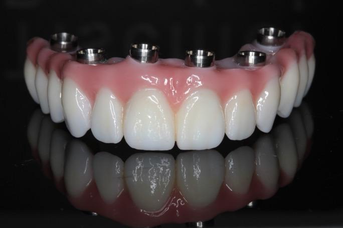 implant supported dentures