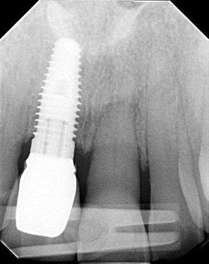 San Rafael implant dentistry