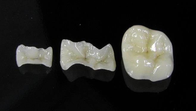 restorative inlays and onlays for crown strengthening 