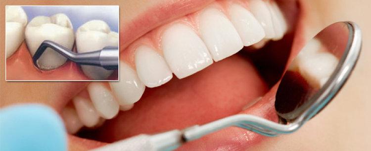 periodontal long term maintenance for bad breath and bacteria