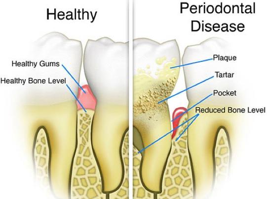 periodontal scaling & root planing treatment for gum disease